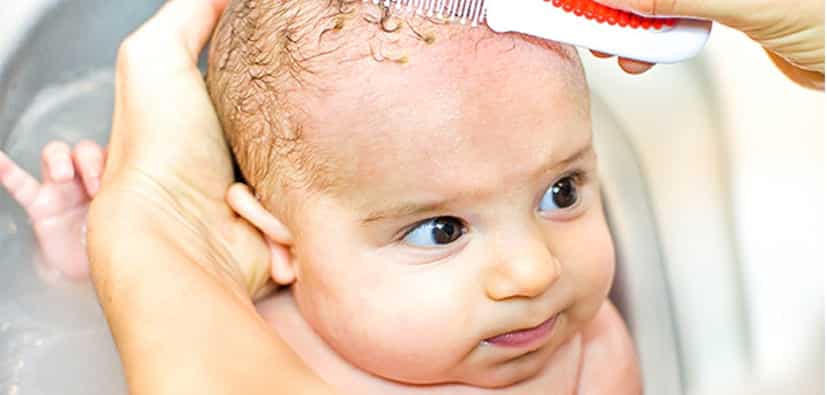 קשקשת תינוקות (סבוריאה) | قشرة الرأس