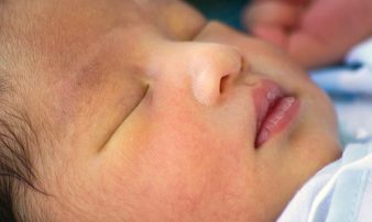 צהבת בתינוקות רכים- תסמינים, בדיקות והפנייה | اليرقان لدى الأطفال -الأعراض والفحوصات